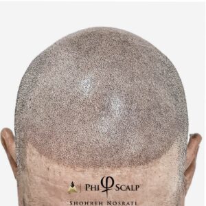 Scalp Micropigmentation Training PhiScalp