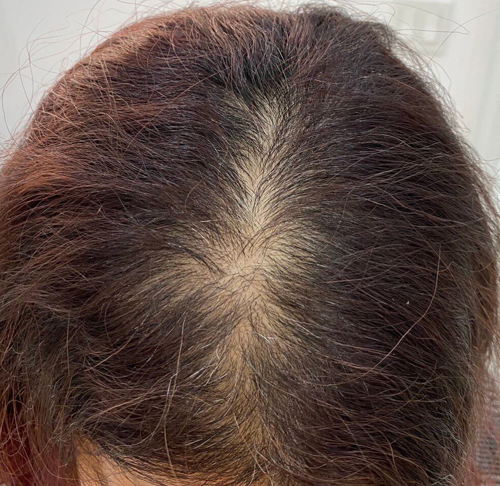 Scalp Micropigmentaion Toronto For Women