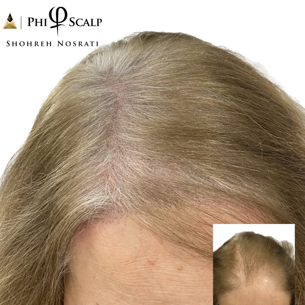 Scalp Micropigmentation (SMP), an Advanced Bald Head Tattooing