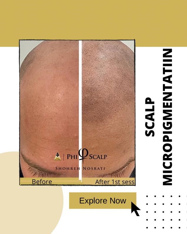 Scalp Micropigmentation to Conceal Hair Loss