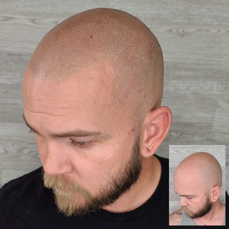 Scalp Micropigmentation Before and After Pictures