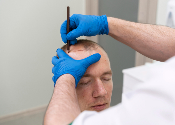 Hairline restoration scalp micropigmentation 