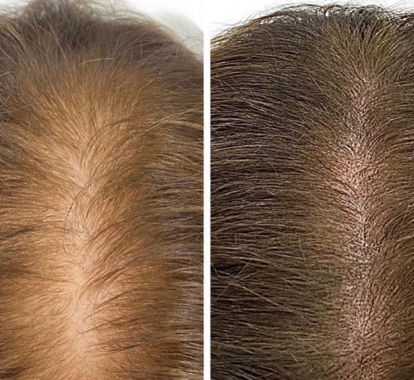 Scalp micropigmentation for women in Toronto at Golden Pulse Academy