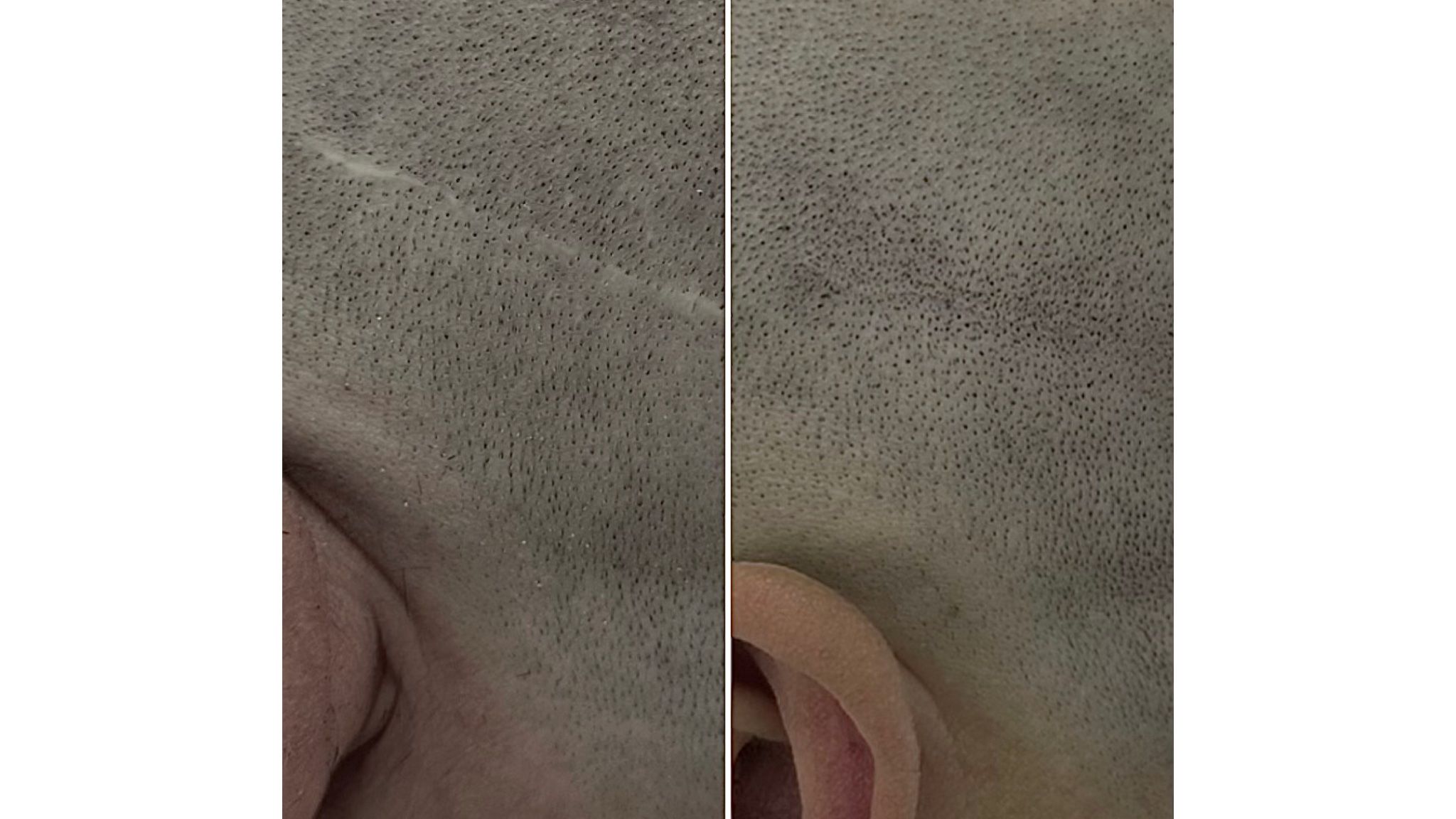 camouflaging a hair transplant scar with natural-looking results in Toronto