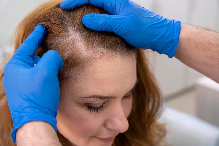 Women Hair loss Treatment SMP in Toronto