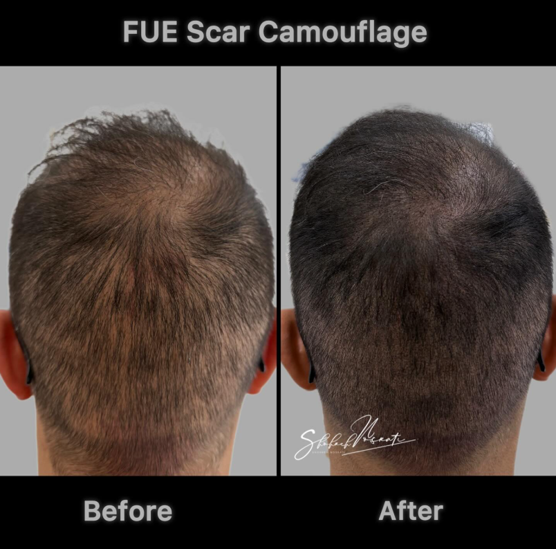 Technician performing scalp micropigmentation treatment using micro-needles on thinning hairline