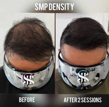 Scalp micropigmentation before and after showing fuller natural hairline without hair transplant