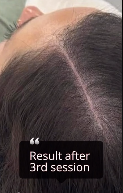Scalp Micropigmentation for Women Hair Thinning Solution 
