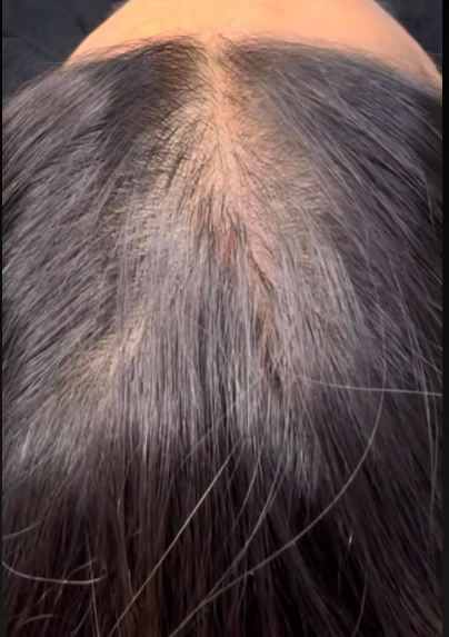 SMP for Women Hair Thinning Solution 