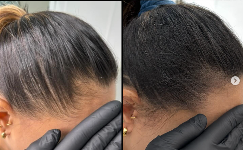 Hair Thinning Solution Toronto