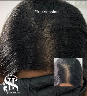 Best Scalp Micropigmentation For Women in Toronto