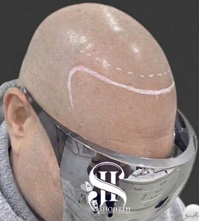 Hairline Restoration by SMP