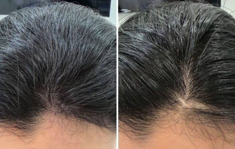 Women Hair Loss Solution